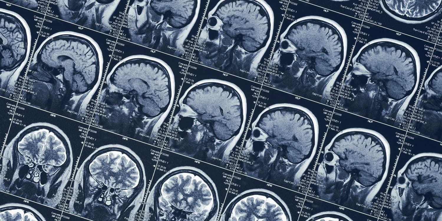 Neuroimaging Reveals How a Woman Voluntarily Enters a Drug-Free Psychedelic-Like Trance: A Groundbreaking Case Study