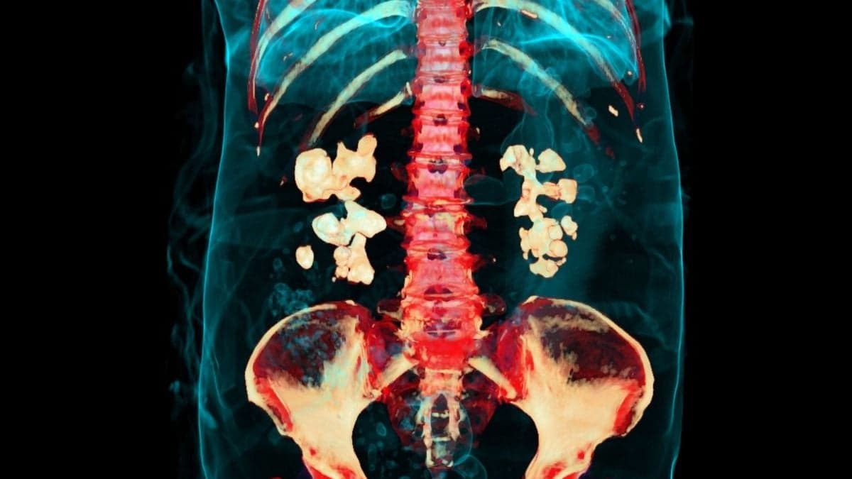 Bacteria Play Previously Unknown Role in Kidney Stones, Study Finds - ScienceAlert