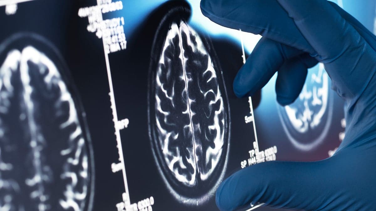 Viagra May Be One of Our Best Existing Options For an Alzheimer's Treatment