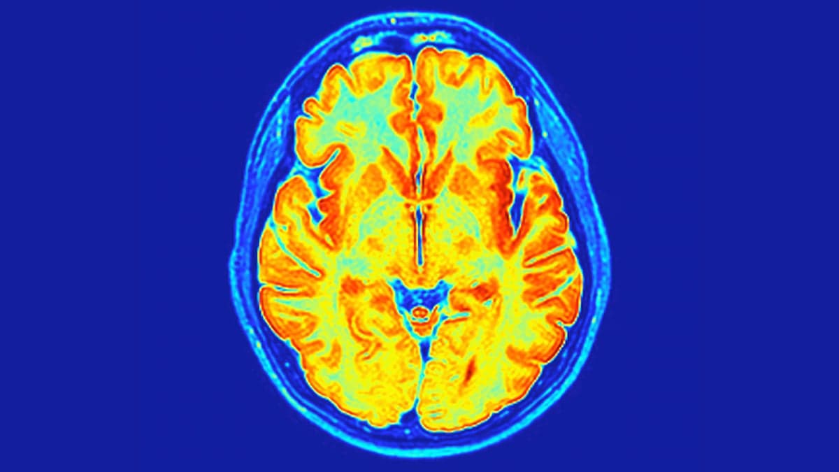 Scientists Discover ReNU2 Syndrome: Gene Mutation Linked to Rare Neurodevelopmental Disorder Affecting Thousands