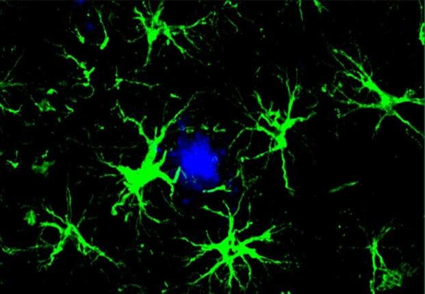 Breakthrough CAR-T Cell Therapy Shows Promise in Targeting Alzheimer’s Plaques in Veterans at Risk