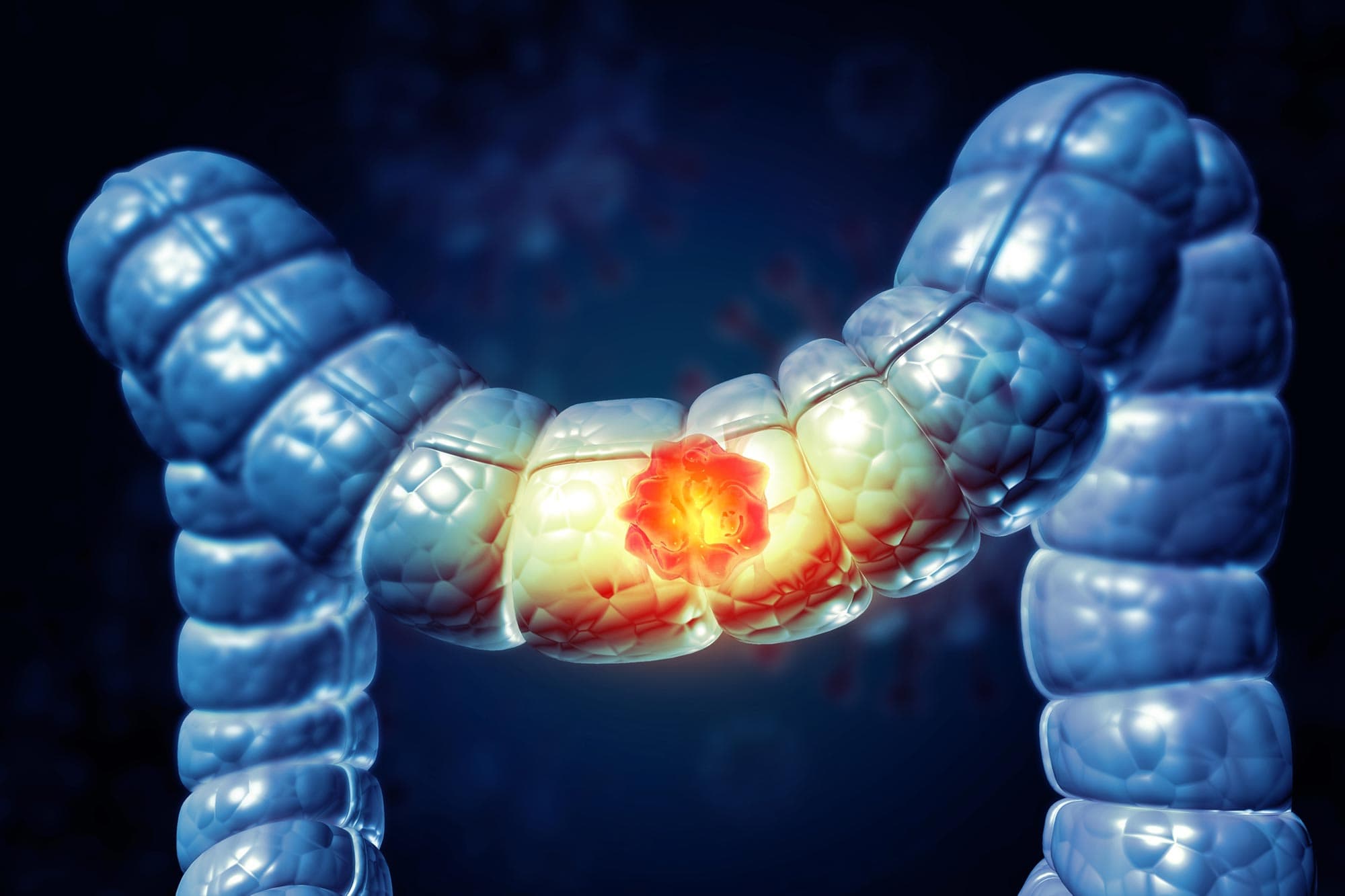 Why Colon Cancer Is Rising in Young Adults: Scientists Discover Unexpected Physical Clue - SciTechDaily