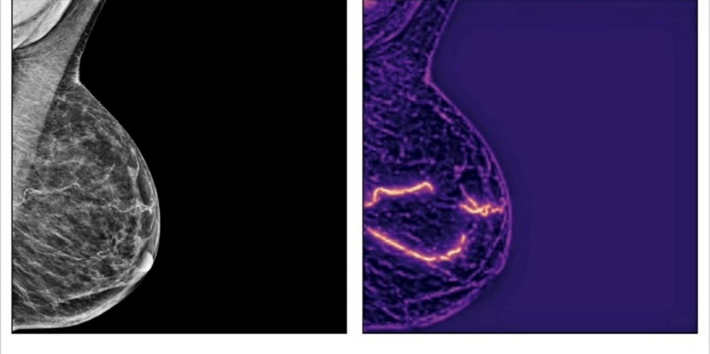 Significant Heart Disease Risk Can Be Detected from Routine Mammograms Using AI - Up to 70% Greater