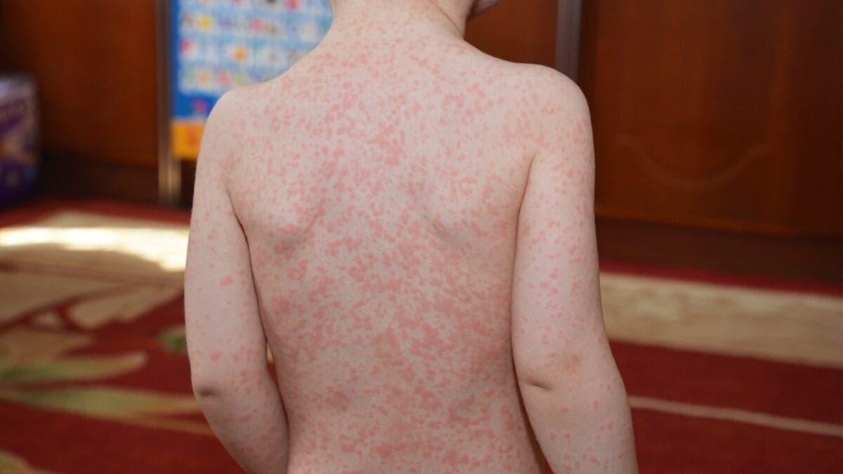 Teenage Mono Linked to Tripled Risk of Multiple Sclerosis Later in Life, Study Finds