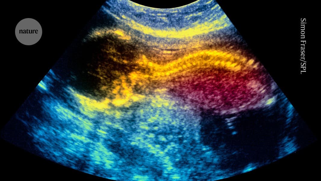 World-first stem-cell therapy shows promise for treating spina bifida in the womb - Nature