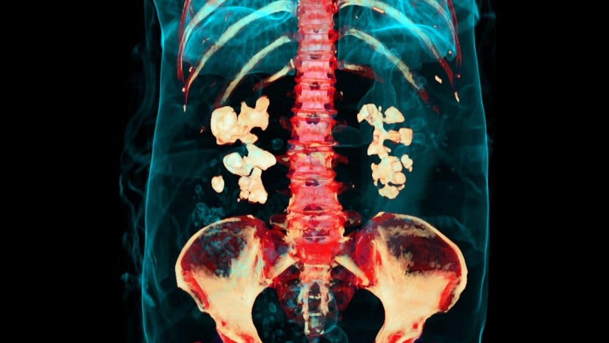 Bacteria Play Previously Unknown Role in Kidney Stones, Study Finds - ScienceAlert