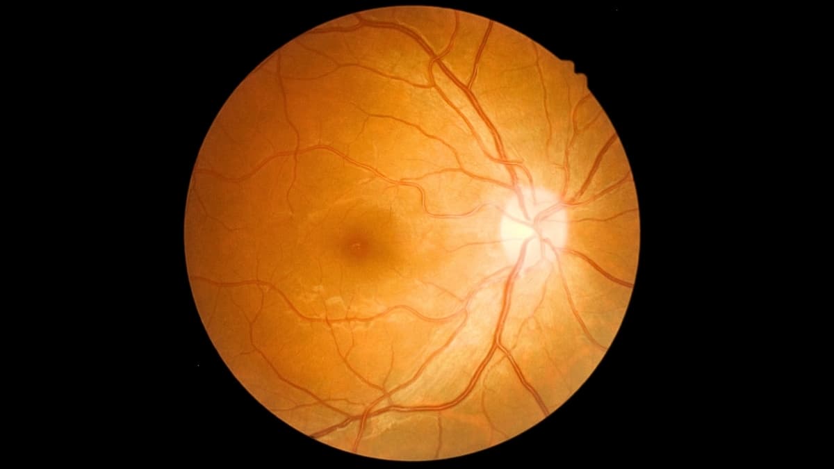 Weight-Loss Drug Wegovy Linked to Rare Eye Stroke Risk: What Patients Need to Know
