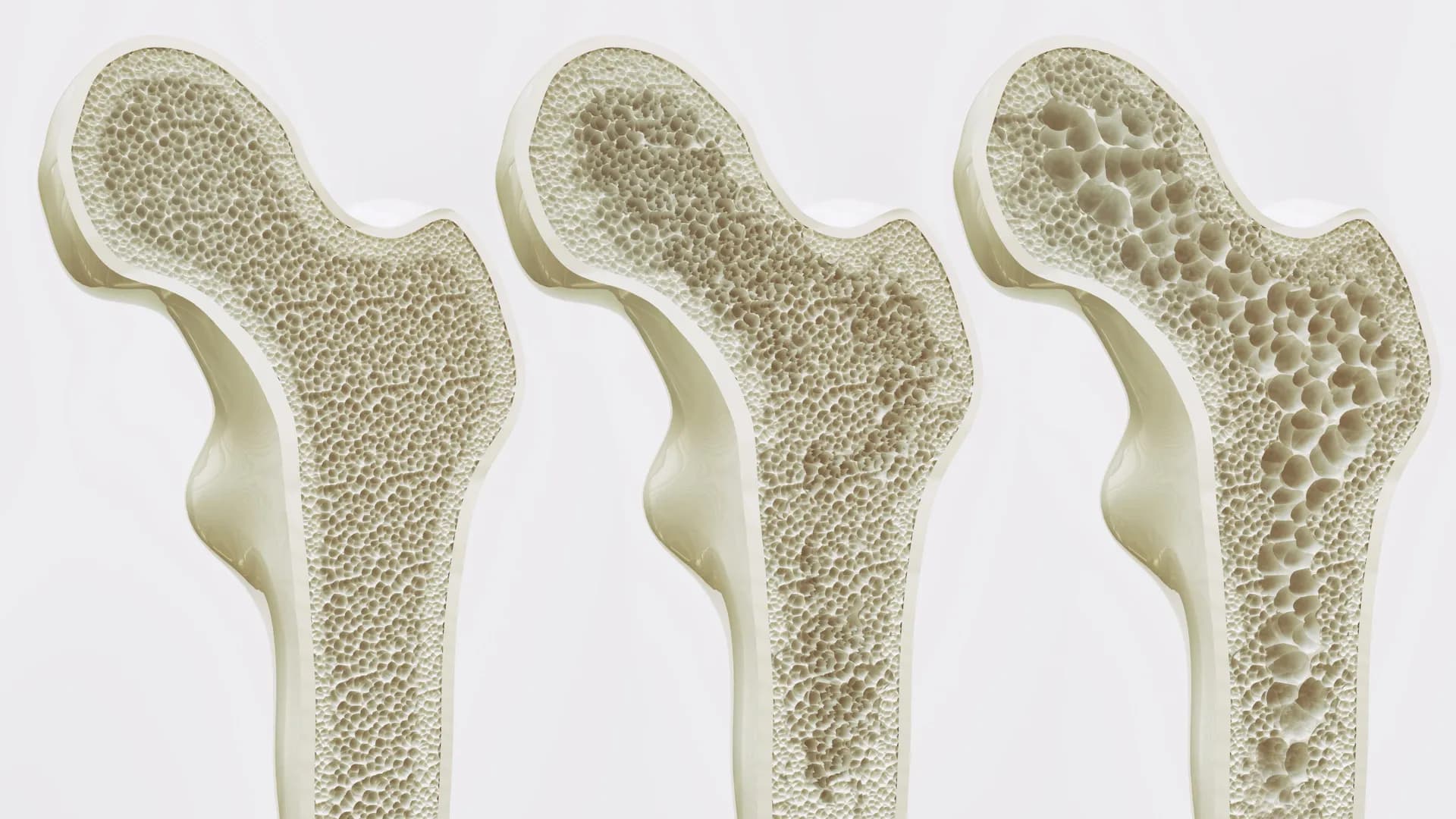 Newly Discovered Bone-Strengthening Receptor GPR133 Offers Hope for Osteoporosis Treatment