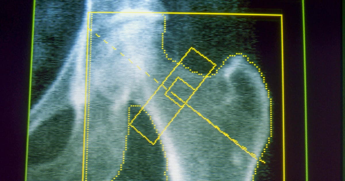 GLP-1s may increase risk of osteoporosis and gout, new research finds - NBC News