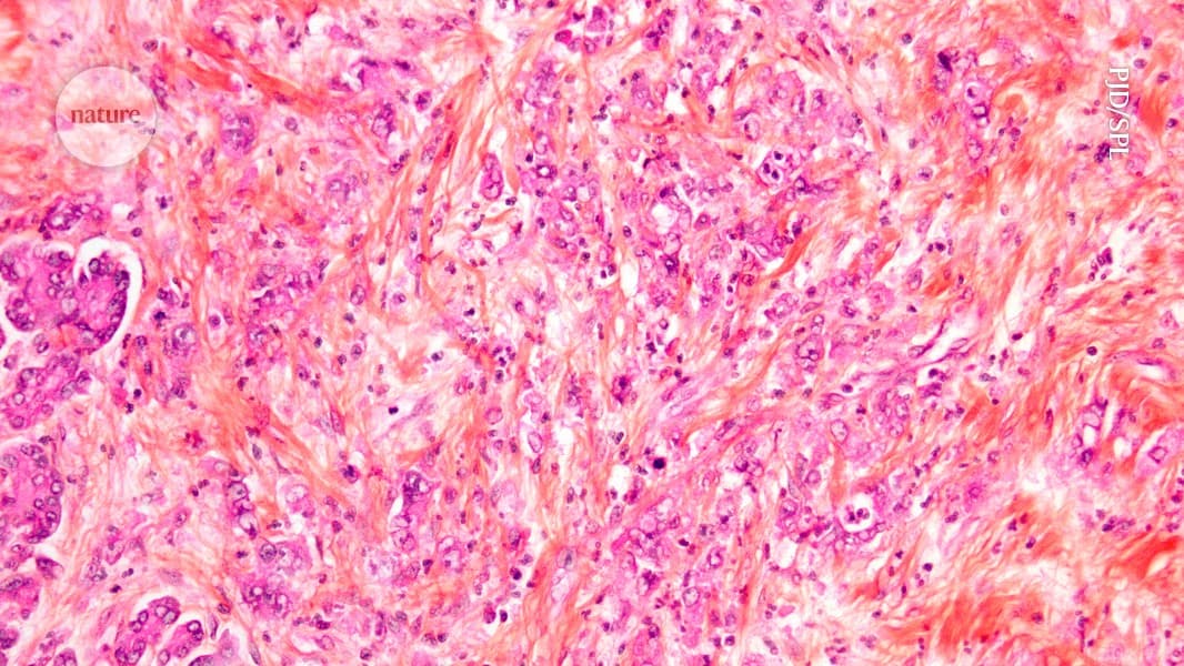 New Cancer Drugs Target 'Undruggable' KRAS Mutations, Offering Renewed Hope