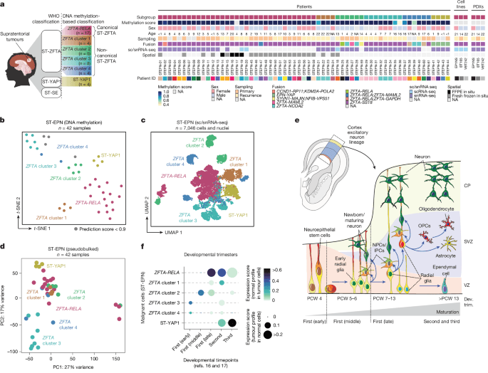 Multidimensional profiling of heterogeneity in supratentorial ependymomas - Nature