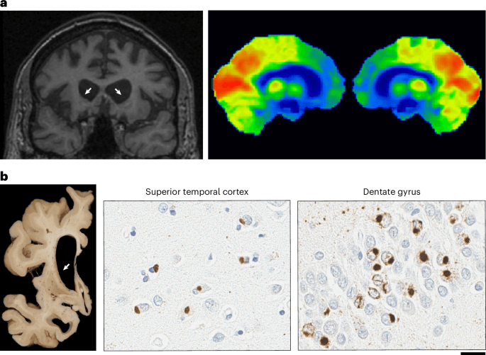 A repeat expansion in GOLGA8A is a major risk factor for atypical frontotemporal lobar degeneration with ubiquitin-positive inclusions