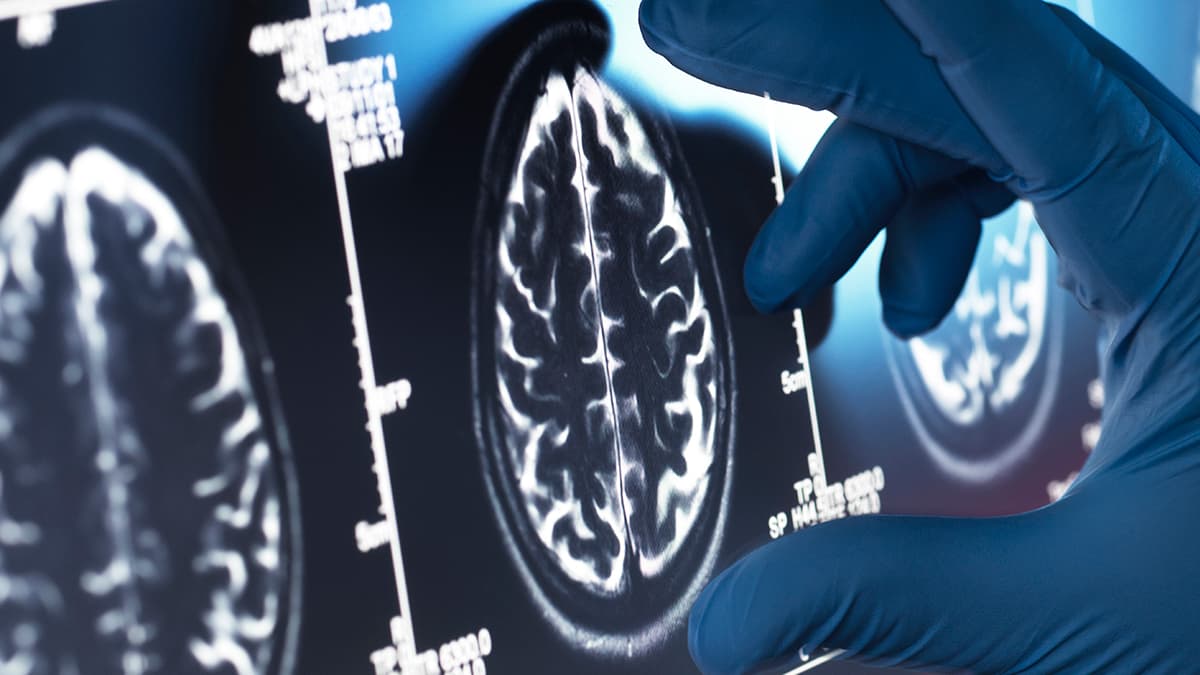 Viagra May Be One of Our Best Existing Options For an Alzheimer's Treatment